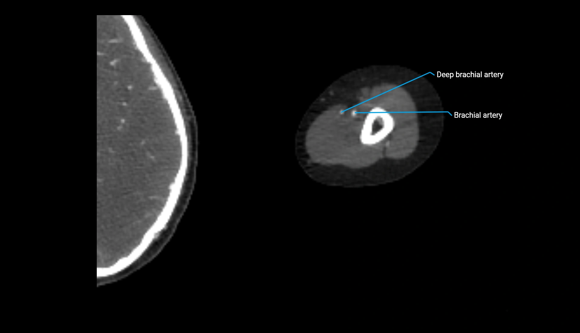 CTA upper limb axial cross sectional anatomy labelled image 243 (2).webp